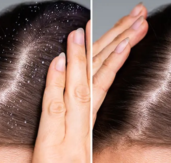 scalp peel.png